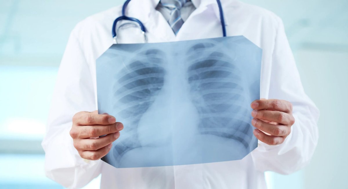 Два случая туберкулеза выявлены среди студентов в СКО