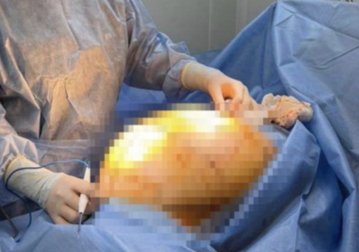 Пыталась вылечить БАДами: у алматинки удалили опухоль весом почти 25 кг