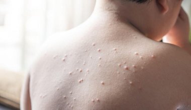 В одном регионе Казахстана выявляют все больше случаев кори у детей