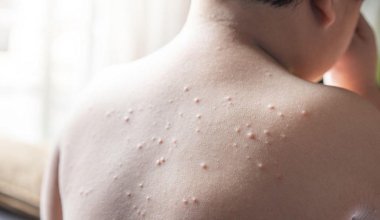 Вспышка кори в школе Алматы: учеников младших классов отправили на удаленку
