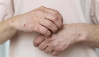В Атырауской области больным корью не хватает мест в стационарах