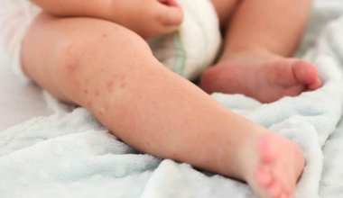 Вспышка кори в Астане: врачи предпринимают срочные меры