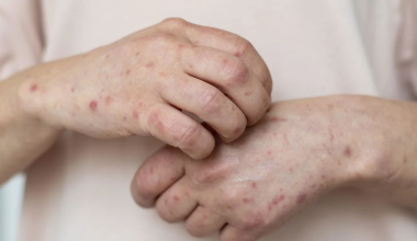 Почему в Казахстане много заболевших корью?